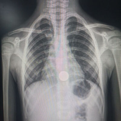 Imagem da notícia Criança de 7 anos engole moeda em Paraíso das Águas e passa por cirurgia na Capital
